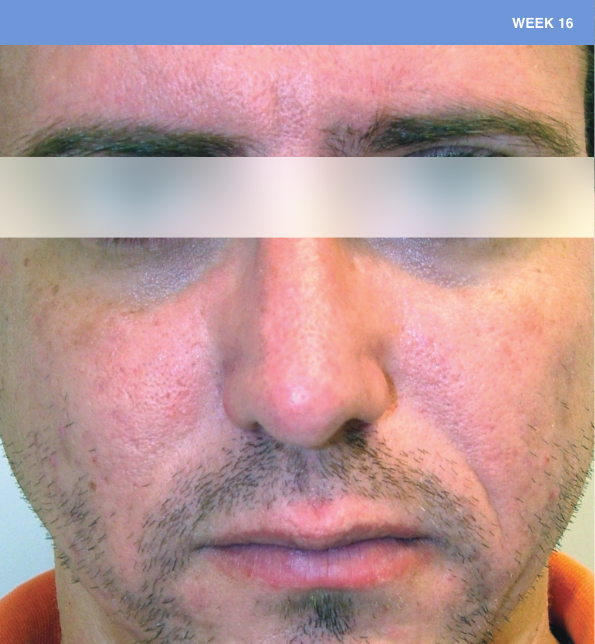 Sliding scale of young man face with lesions of rosacea at baseline to week 16 showing burden of roacea on his cheeks, forehead and nose then showing nearly clear skin.